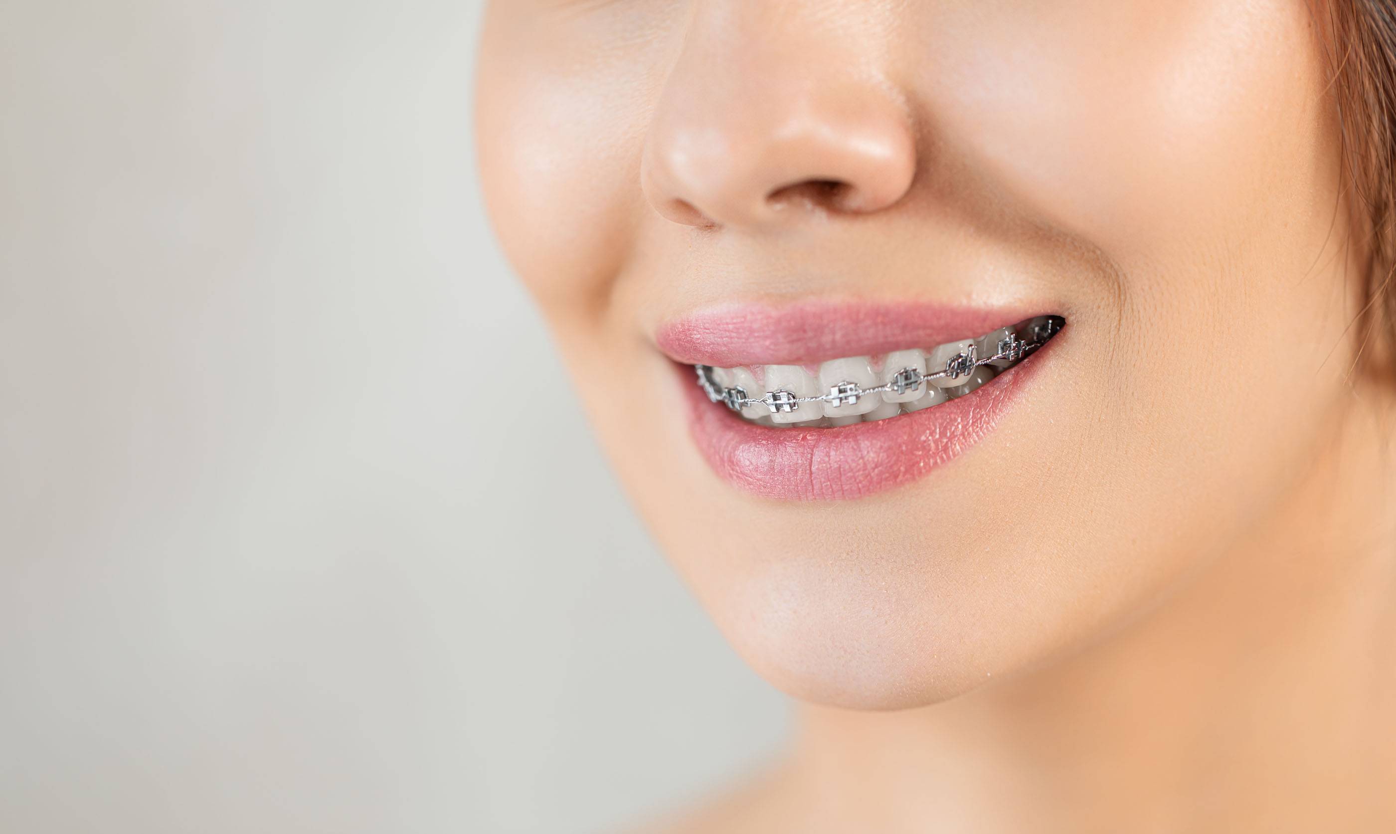 Крупный план зубов с металлическими брекетами. Здоровая улыбка. Уход за зубами и ортодонтическое лечение.